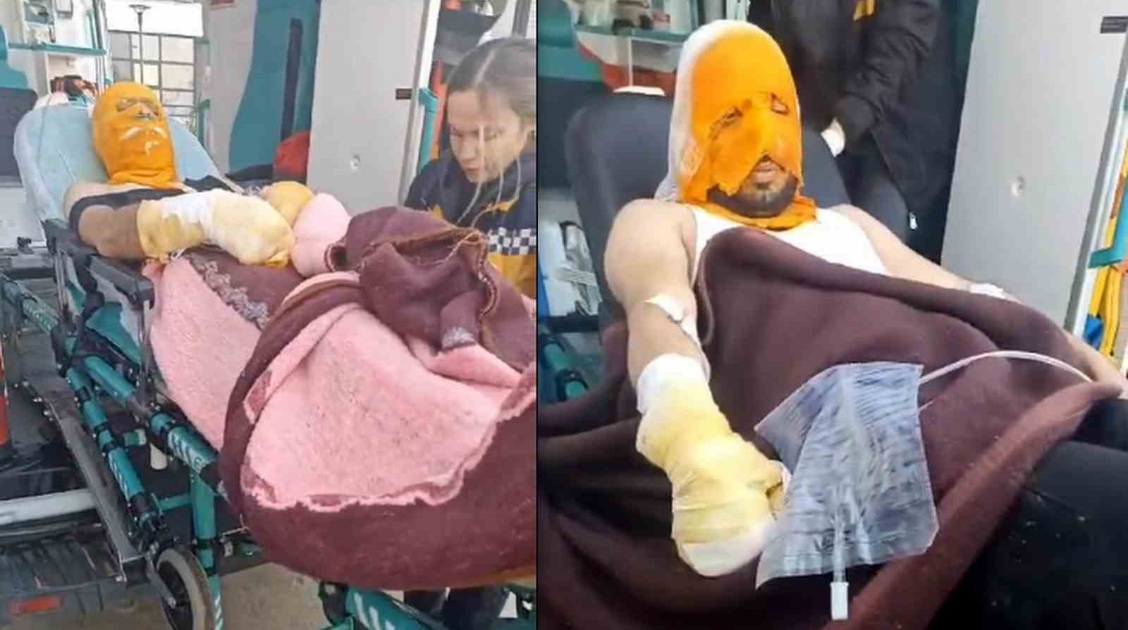 Erzincanda Trafo Patlaması Sonucu 2 Aras Edaş Personeli Yaralandı